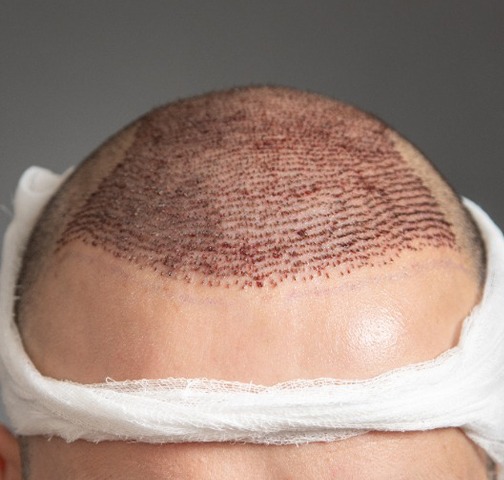 Hair transplant surgery at Sumanova Hair Clinic Hyderabad