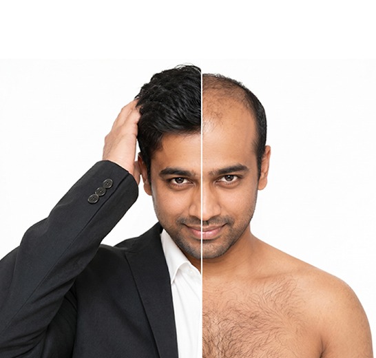 Male hair loss consultation at Sumanova