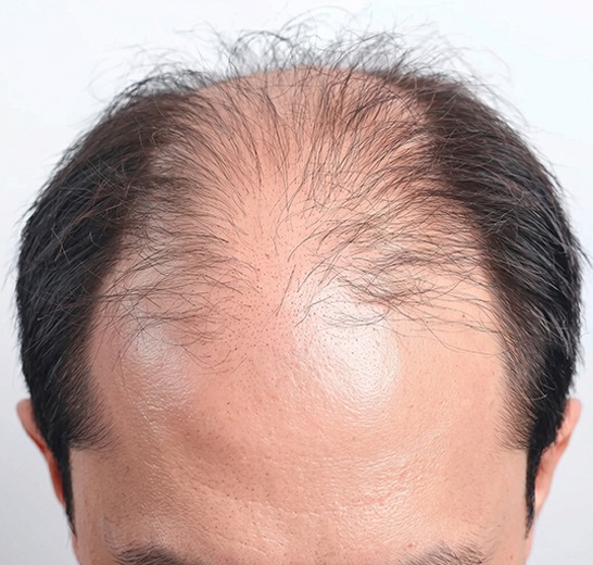 Hair thinning solutions at Sumanova